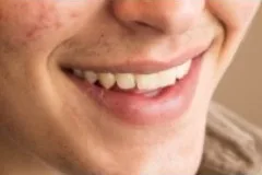 Teeth whitening: Original